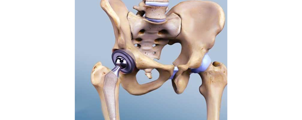 Best Hip Replacement Surgeon in Koramangala