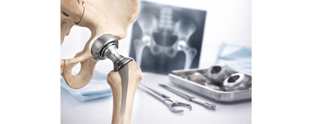 How to Find the Best Hip Replacement Surgeon in Nagarbhavi?