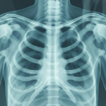 X-ray showing proximal humerus fracture before and after surgical fixation