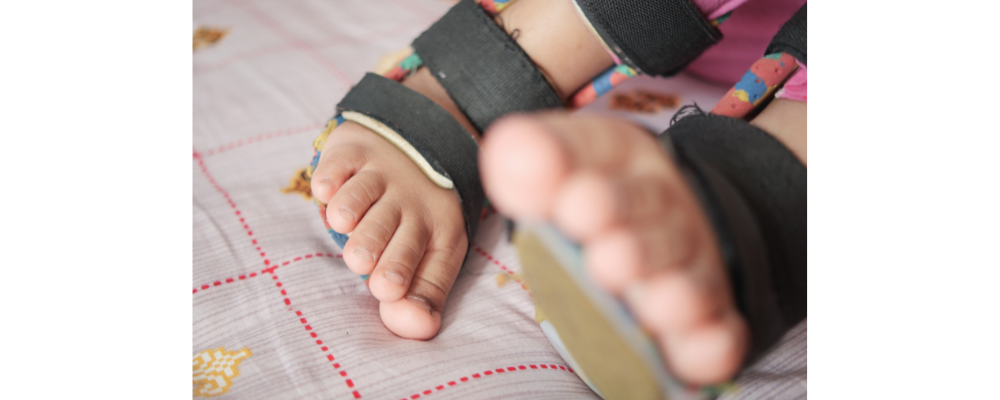 Clubfoot in Newborns: What Bangalore Parents Must Know About Early Treatment