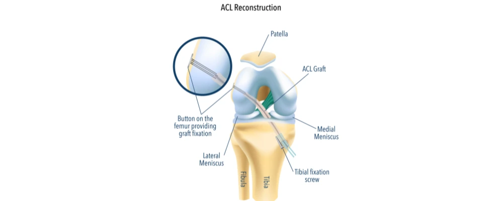 Return to Work After ACL Surgery in Bangalore: A Timeline for Office and Physical Jobs