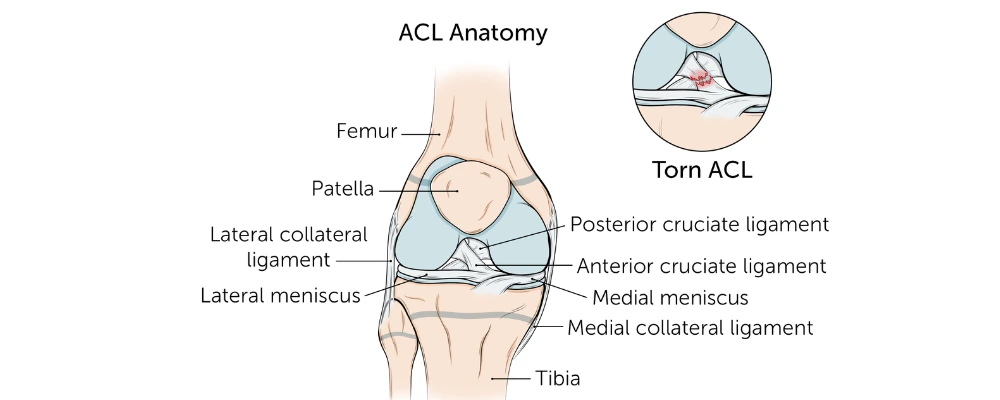 ACL Surgery in Bangalore: Hamstring Graft vs Patellar Tendon — Which Is Better?